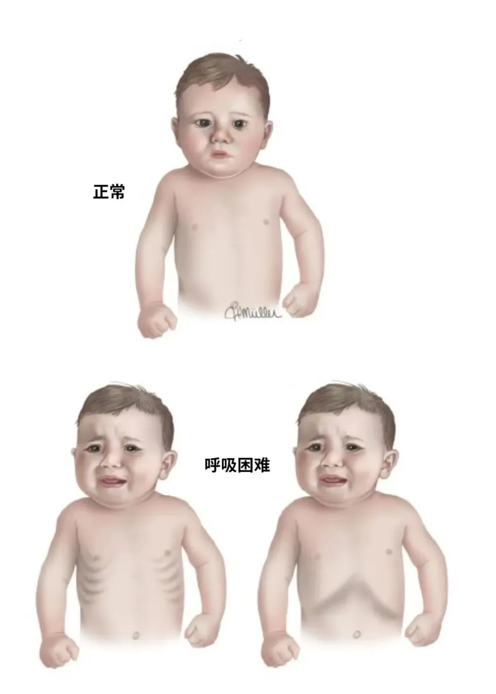 流感病毒交叉感染_支原体感染交叉感染_23儿科已出现流感与支原体交叉感染